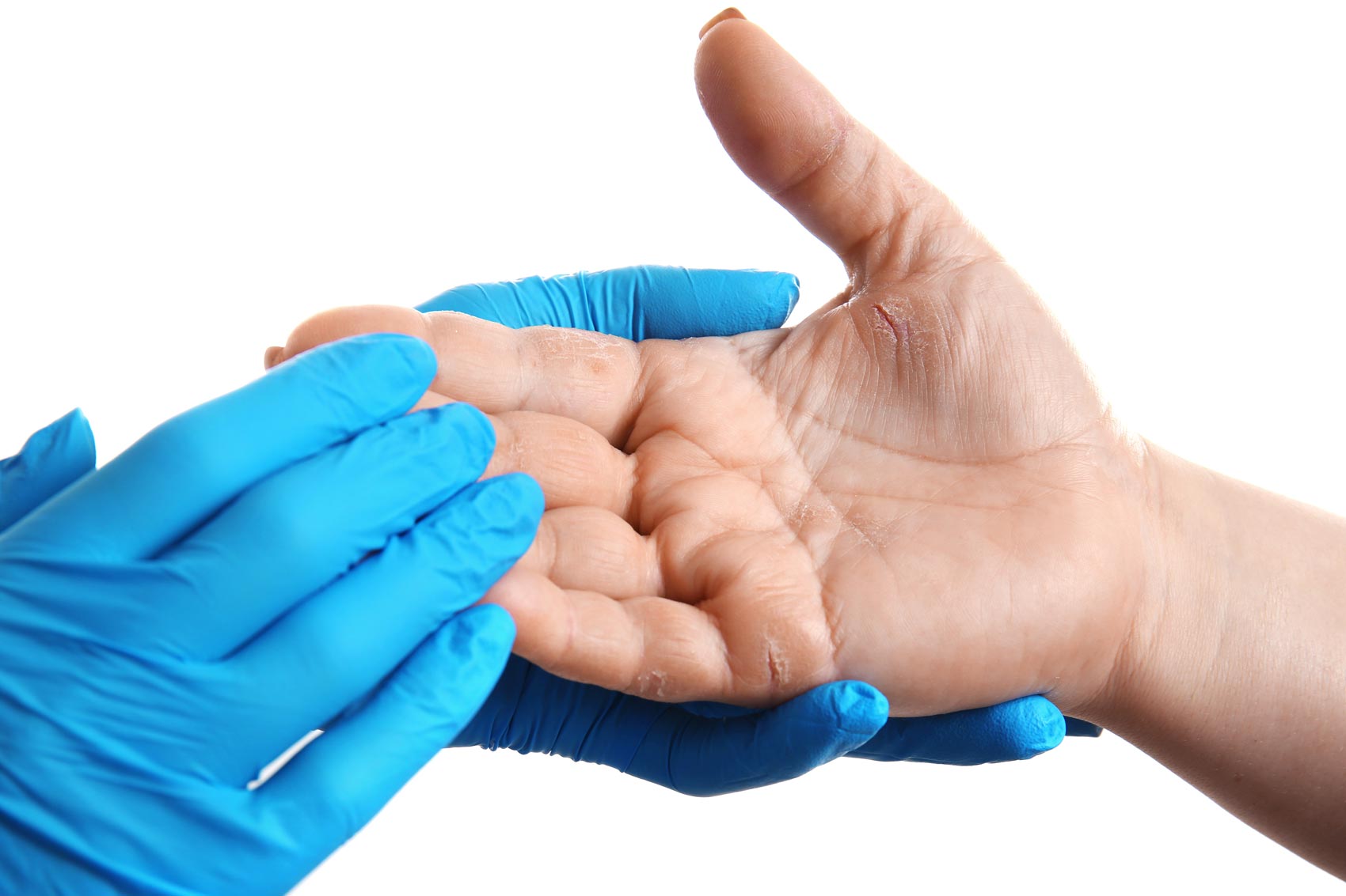 Alergije na rokavice iz nitrila – vzroki, simptomi in preprečevanjeAlergije na rokavice iz nitrila – vzroki, simptomi in preprečevanje