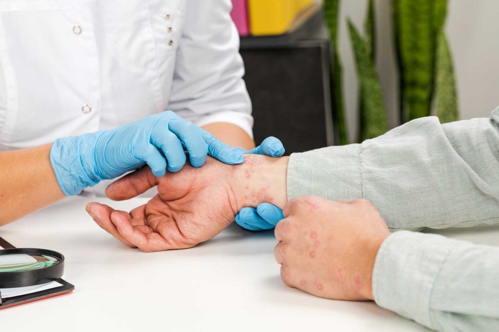 Zdravnik v modrih nitrilnih rokavicah pregleduje izpuščaje na rokah pacienta
